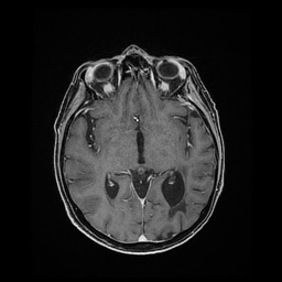 Balo concentric sclerosis (Radiopaedia 53875-59982 Axial LAVA C+ 125).jpg