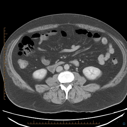 File:Bariatric balloon causing gastric outlet obstruction (Radiopaedia 54449-60672 A 23).jpg