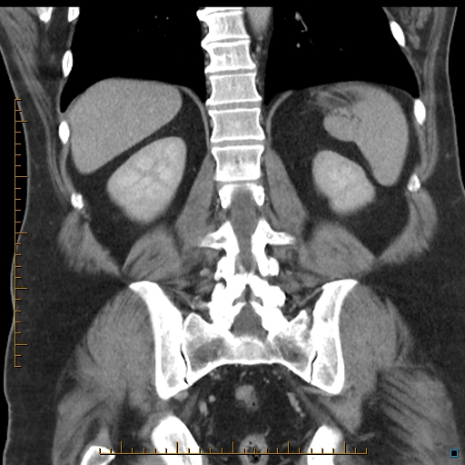 File:Bariatric balloon causing gastric outlet obstruction (Radiopaedia 54449-60672 B 44).jpg