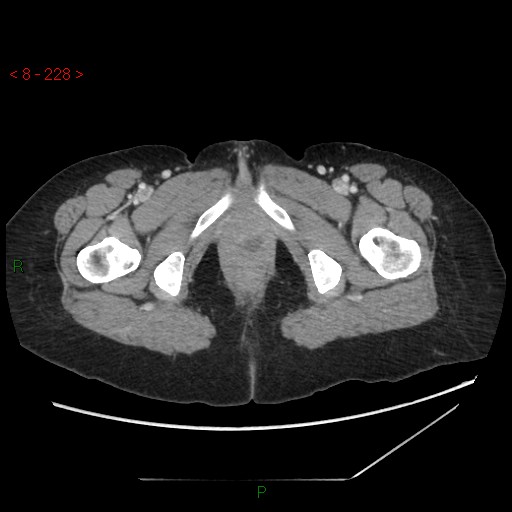 Bartholin gland cyst (Radiopaedia 54904-61181 A 57).jpg