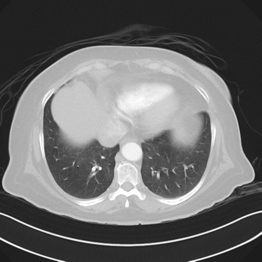 Basal ganglia metastasis (Radiopaedia 78928-91832 B 36).png