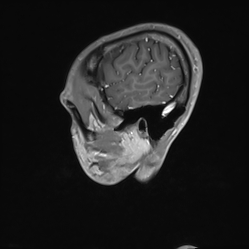 Basilar artery perforator aneurysm (Radiopaedia 82455-97733 G 21).jpg