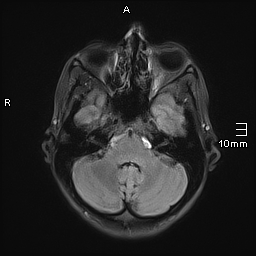 File:Basilar artery perforator aneurysm (Radiopaedia 82455-99523 Axial FLAIR 6).jpg