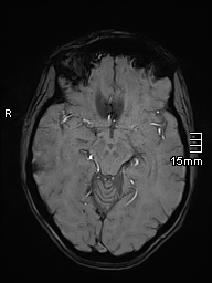 Basilar artery perforator aneurysm (Radiopaedia 82455-99523 Axial SWI 27).jpg