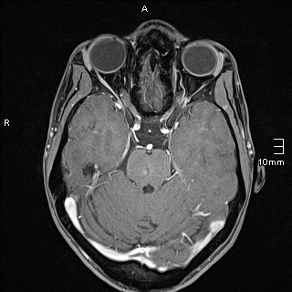 File:Basilar artery perforator aneurysm (Radiopaedia 82455-99523 G 46).jpg