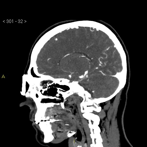 File:Basilar artery thrombosis (Radiopaedia 16260-15944 C 26).jpg