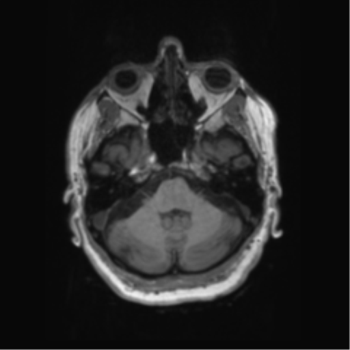 File:Behavioral variant frontotemporal dementia and late onset schizophrenia (Radiopaedia 52197-58083 Axial T1 87).png