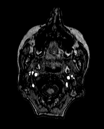 Berry aneurysm of the terminal internal carotid artery (Radiopaedia 88286-104918 Axial TOF 11).jpg