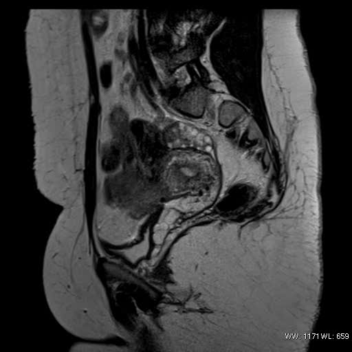 File:Bicornuate uterus- on MRI (Radiopaedia 49206-54297 Sagittal T2 9).jpg