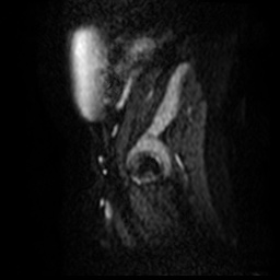 File:Bicornuate uterus (Radiopaedia 51676-57472 Sagittal DWI 2).jpg