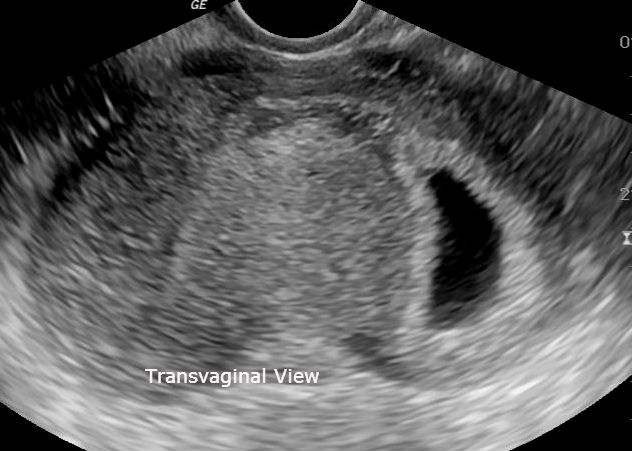 File:Bicornuate uterus with early pregnency (Radiopaedia 23147-23191 B 1).jpg