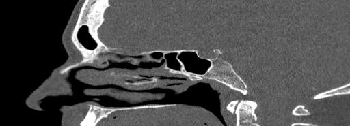 File:Bilateral Ectopic Infraorbital Nerves (Radiopaedia 49006-54084 Sagittal bone window 25).jpg