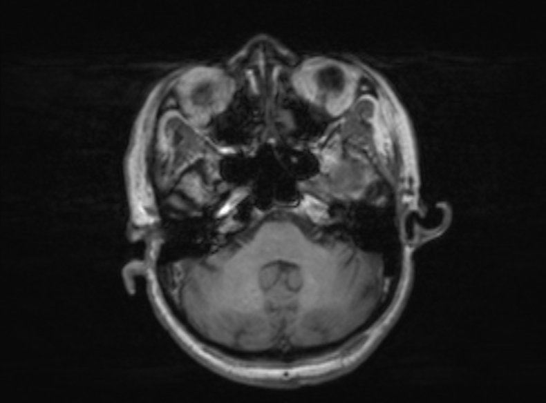 Bilateral PCA territory infarction - different ages (Radiopaedia 46200-51784 Axial T1 308).jpg