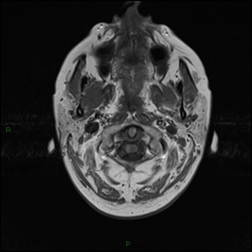 File:Bilateral acute middle cerebral artery territory infarcts (Radiopaedia 77319-89402 Axial T1 1).jpg