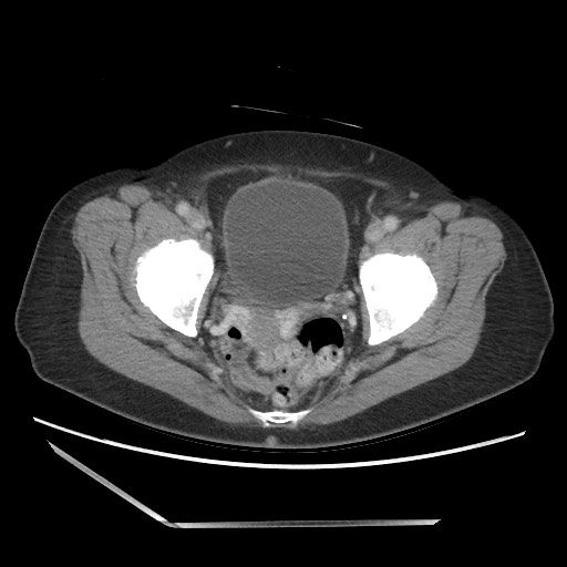 Bilateral adrenal granulocytic sarcomas (chloromas) (Radiopaedia 78375-91007 A 107).jpg