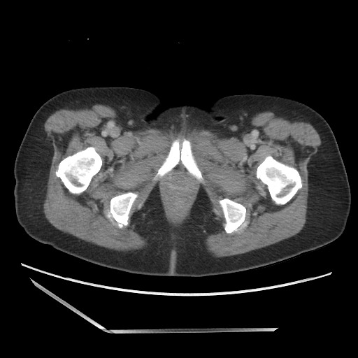Bilateral adrenal granulocytic sarcomas (chloromas) (Radiopaedia 78375-91007 A 124).jpg