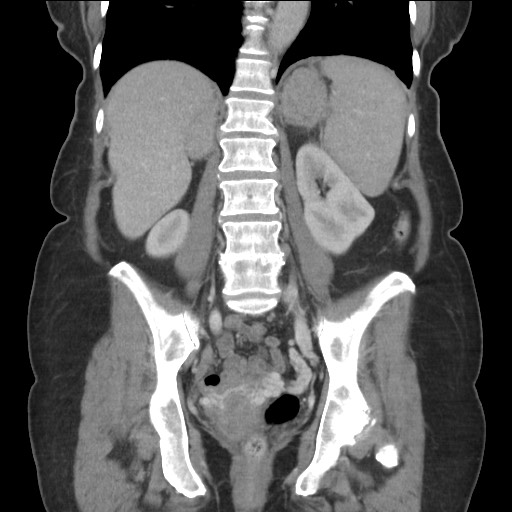 Bilateral adrenal granulocytic sarcomas (chloromas) (Radiopaedia 78375-91007 B 61).jpg