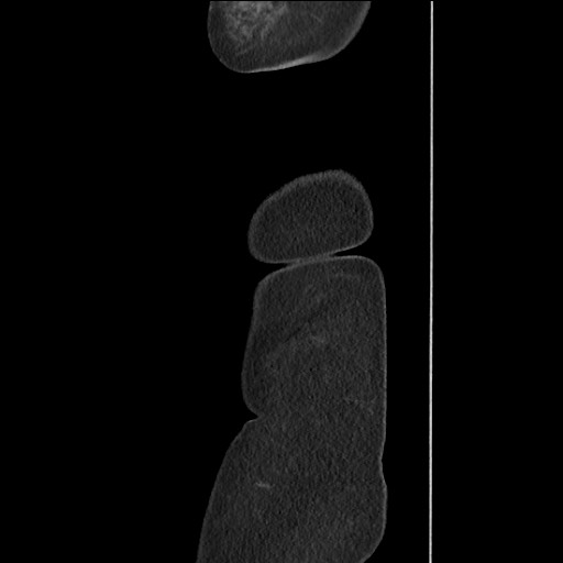 Bilateral adrenal granulocytic sarcomas (chloromas) (Radiopaedia 78375-91007 C 135).jpg