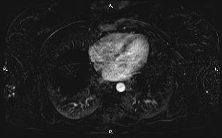 Bilateral adrenal myelolipoma (Radiopaedia 63058-71537 I 6).jpg