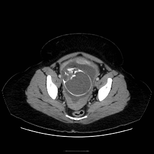 Bilateral adrenal thrombosis (Radiopaedia 58182-65256 A 68).jpg