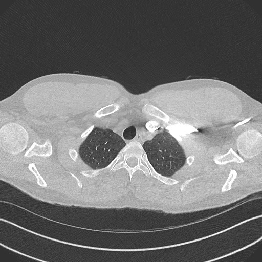 Bilateral atelectasis (Radiopaedia 48666-53675 Axial lung window 10).jpg