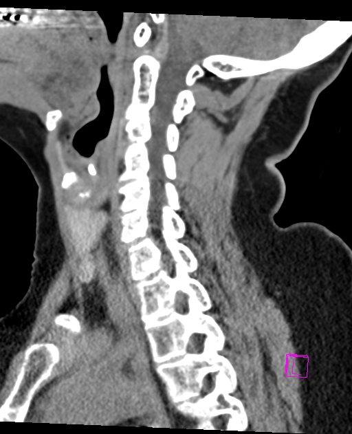 Bilateral atlanto-occipital assimilation (Radiopaedia 28350-28603 D 34).jpg