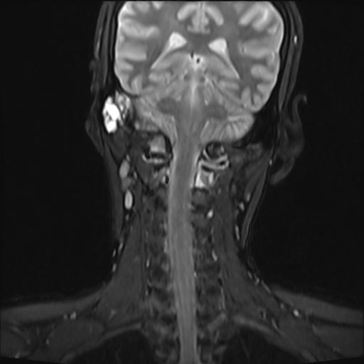 File:Bilateral carotid body tumors and right jugular paraganglioma (Radiopaedia 20024-20060 Coronal 37).jpg