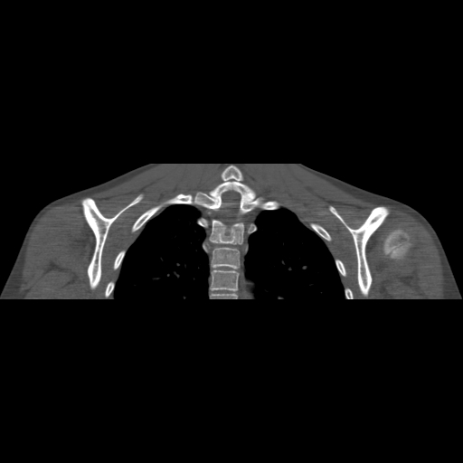 Bilateral chronic posterior shoulder dislocation (Radiopaedia 39213-41452 Coronal bone window 41).jpg