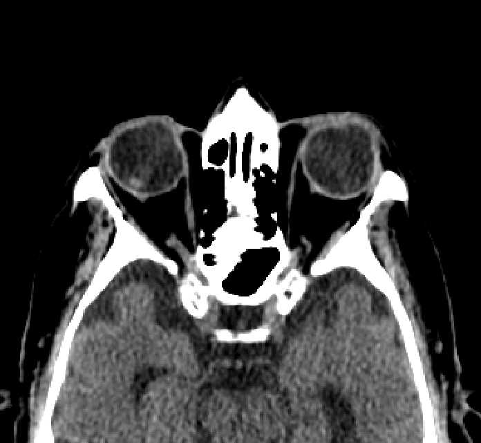 Bilateral ectopia lentis (Radiopaedia 89889-107013 Axial non-contrast 37).jpg