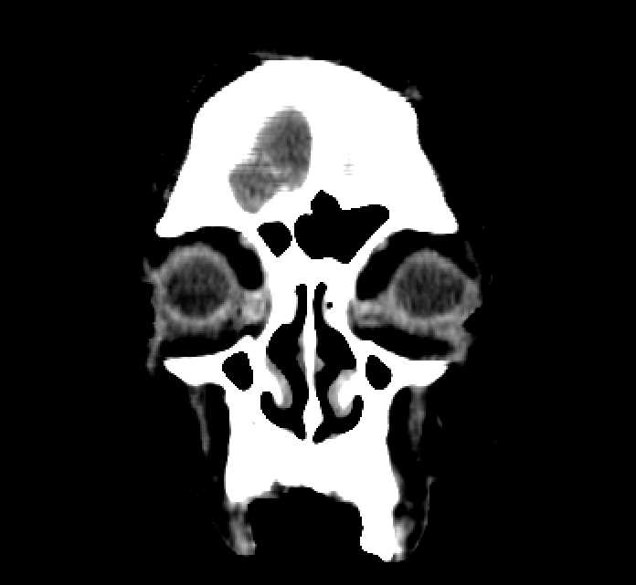 Bilateral ectopia lentis (Radiopaedia 89889-107013 Coronal non-contrast 16).jpg