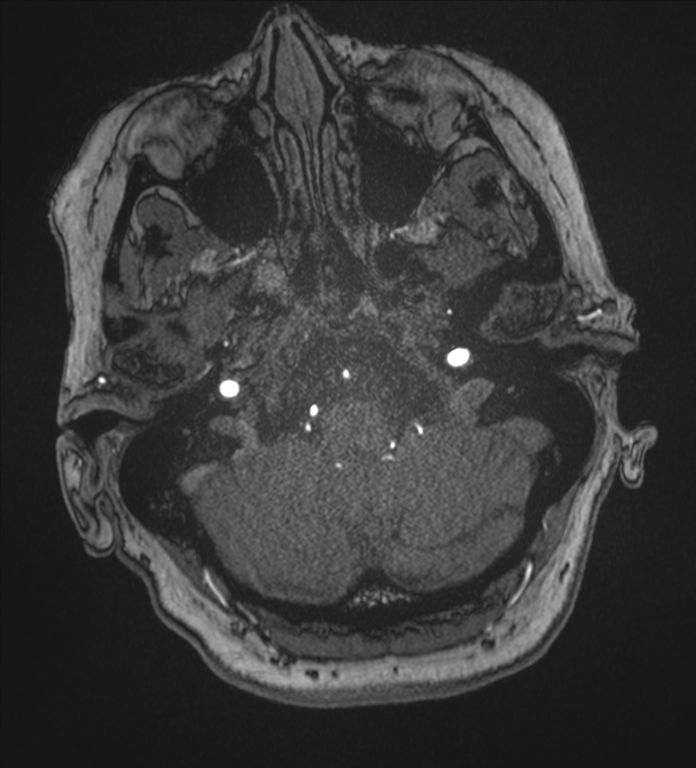 Bilateral fetal posterior communicating arteries (Radiopaedia 41286-44102 Axial MRA 18).png