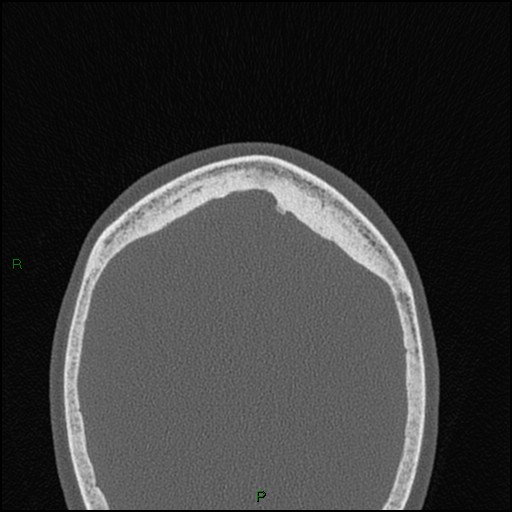 Bilateral frontal mucoceles (Radiopaedia 82352-96454 Axial bone window 9).jpg