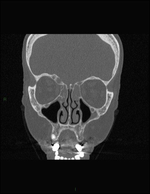 Bilateral frontal mucoceles (Radiopaedia 82352-96454 Coronal 125).jpg