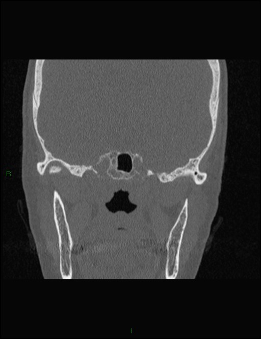 Bilateral frontal mucoceles (Radiopaedia 82352-96454 Coronal 258).jpg