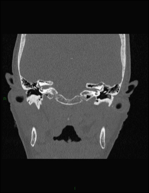 Bilateral frontal mucoceles (Radiopaedia 82352-96454 Coronal 301).jpg