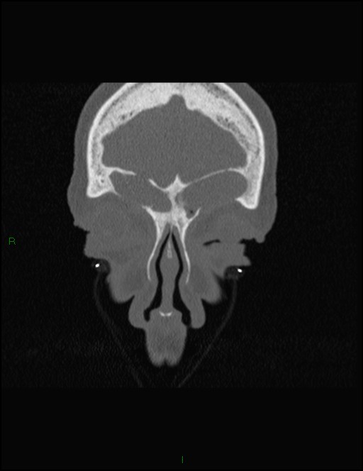 Bilateral frontal mucoceles (Radiopaedia 82352-96454 Coronal 65).jpg