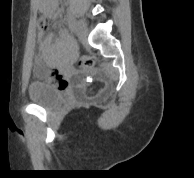 Bilateral mature cystic ovarian teratoma (Radiopaedia 88821-105592 D 47).jpg