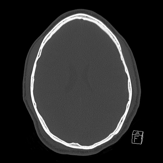 Bilateral occipital condyle fracture (type 2) (Radiopaedia 87675-104089 Axial bone window 86).jpg