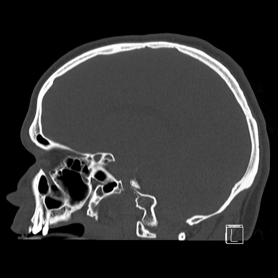 Bilateral occipital condyle fracture (type 2) (Radiopaedia 87675-104089 Sagittal bone window 43).jpg