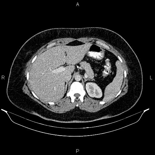 Bilateral ovarian dermoid cysts (Radiopaedia 85785-101603 A 31).jpg