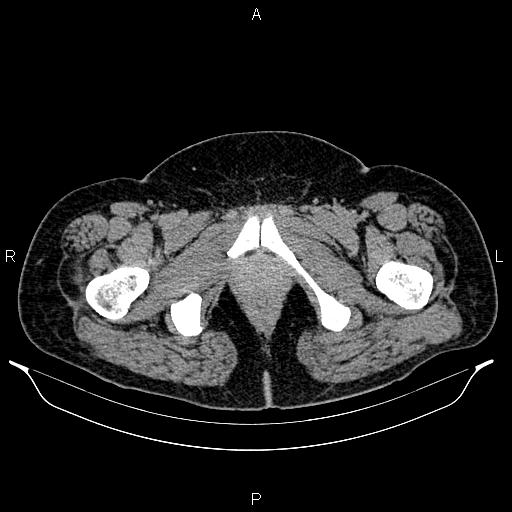 Bilateral ovarian dermoid cysts (Radiopaedia 85785-101603 Axial C+ delayed 92).jpg