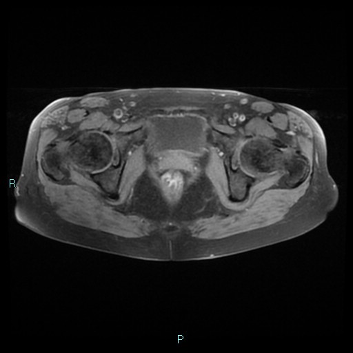File:Bilateral ovarian fibroma (Radiopaedia 44568-48293 Axial T1 fat sat 23).jpg