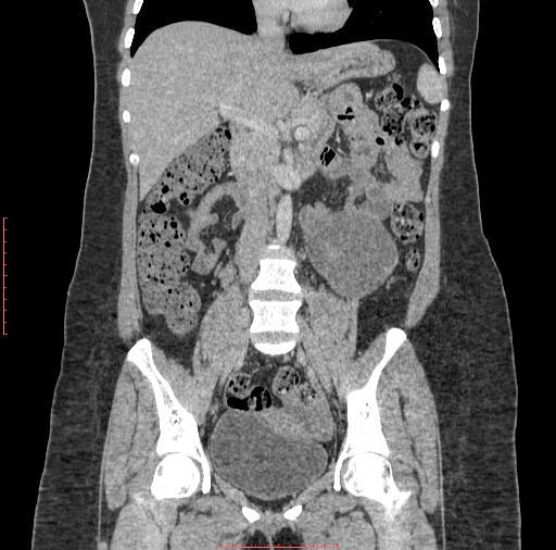 File:Bilateral ovarian serous cystadenocarcinoma with right ovarian torsion (Radiopaedia 32640-33611 B 19).jpg