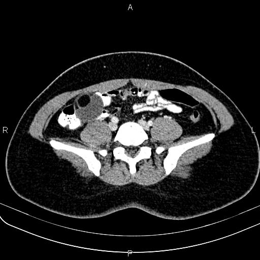 Bilateral ovarian teratoma (Radiopaedia 83131-97503 Axial With contrast 10).jpg
