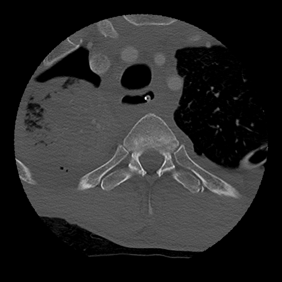 Bilateral perched facets with cord injury (Radiopaedia 45587-49713 Axial bone window 120).jpg