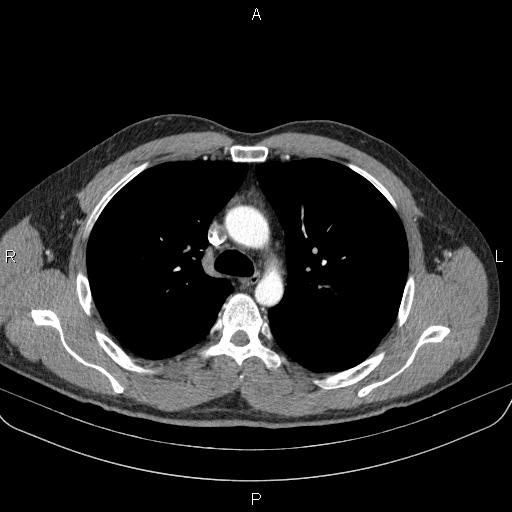 File:Bilateral pulmonary AVM (Radiopaedia 83134-97505 A 25).jpg