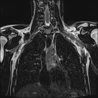 Bilateral spinoglenoid notch ganglion cysts (Radiopaedia 29577-30082 Coronal T2 58).jpg