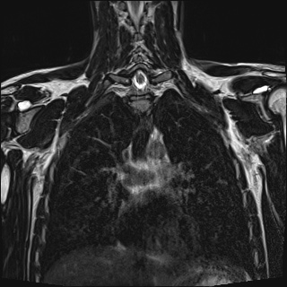 Bilateral spinoglenoid notch ganglion cysts (Radiopaedia 29577-30082 Coronal T2 68).jpg