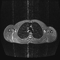 File:Bilateral spinoglenoid notch ganglion cysts (Radiopaedia 29577-30082 E 14).jpg