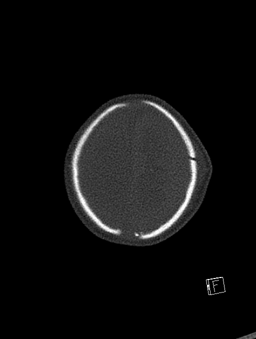 Bilateral subdural hemorrhage and parietal skull fracture (Radiopaedia 26058-26192 Axial bone window 11).png
